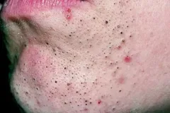 acne-vulgaris-2