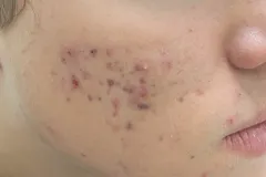 acne-vulgaris-3