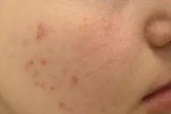 acne-vulgaris-4