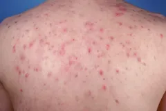 acne-vulgaris