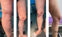 ЕВЛА+мініфлебектомія