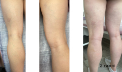 Склеротерапія ретикулярних вен