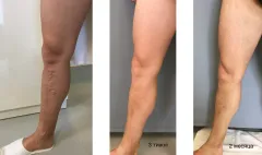 endovenous-laser-ablation-3