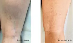 endovenous-laser-ablation-5