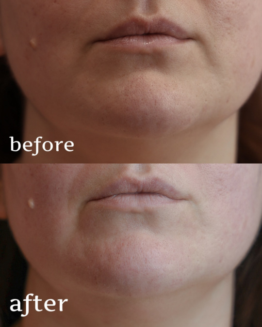 Сучасні методи корекції розширених пор