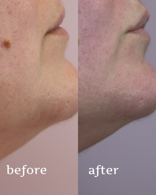 Сучасні методи корекції розширених пор