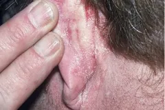 seborrheic-dermatitis-2