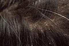 seborrheic-dermatitis-3