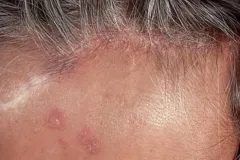 seborrheic-dermatitis-4