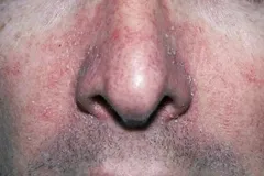 seborrheic-dermatitis