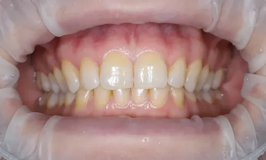 Відбілювання зубів: до процедури