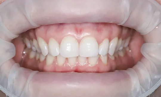 Відбілювання зубів: після процедури