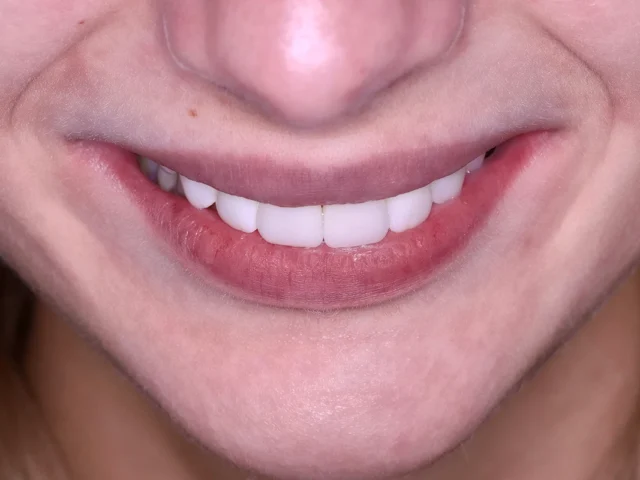 Як встановлюють керамічні вініри: від консультації до ідеальної усмішки