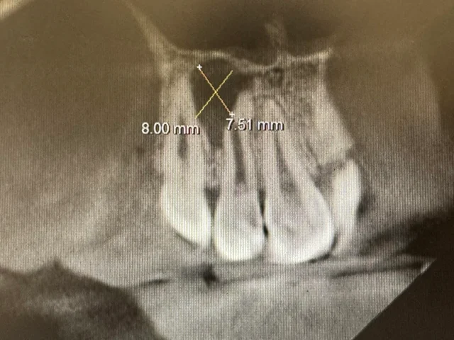 Ускладнення під час лікування кореневих каналів