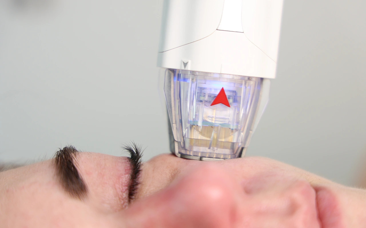 Фізичні методи лікування мелазми