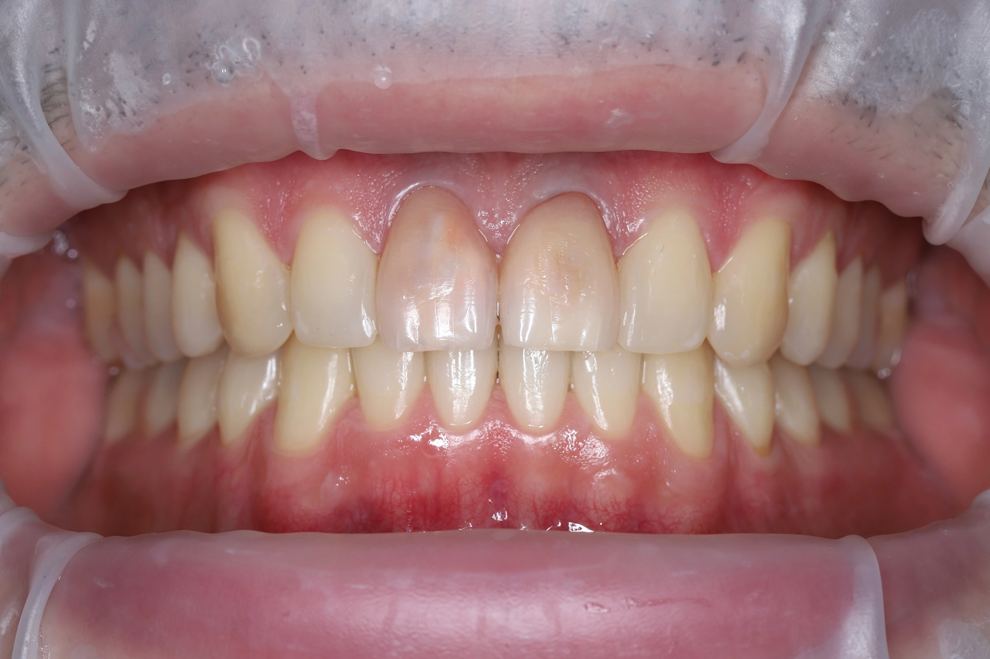 Эстетическое восстановление центральных резцов циркониевыми коронками