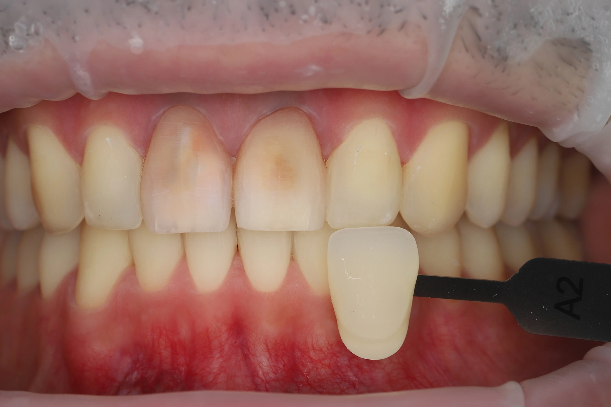 Эстетическое восстановление центральных резцов циркониевыми коронками