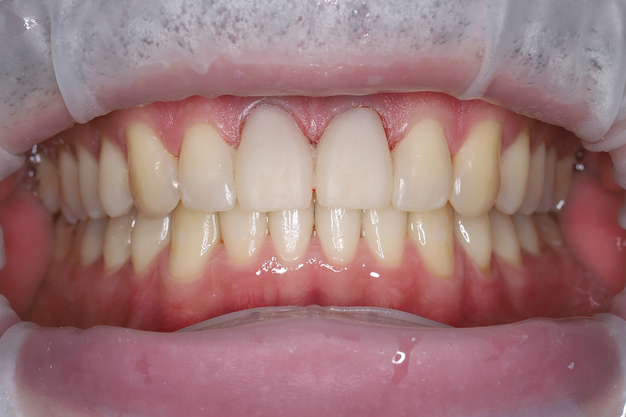 Эстетическое восстановление центральных резцов циркониевыми коронками