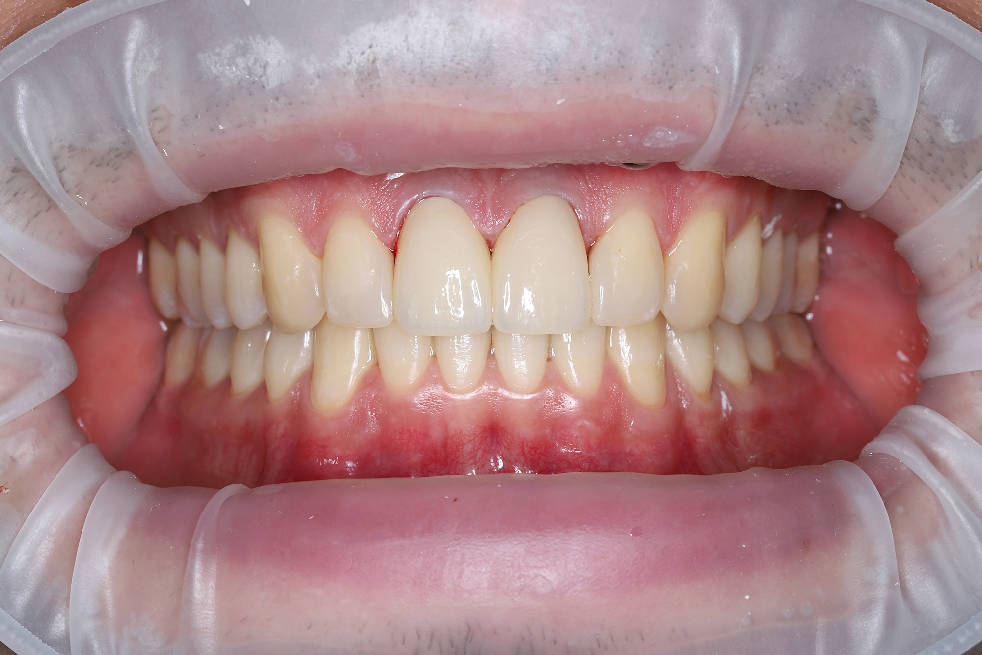 Эстетическое восстановление центральных резцов циркониевыми коронками