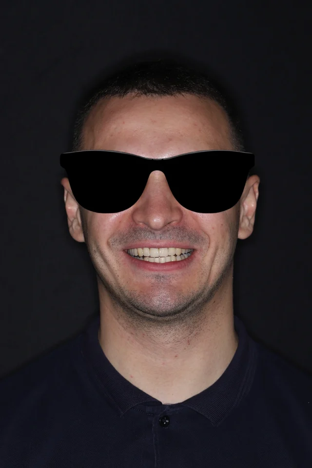 Восстановление передних зубов циркониевыми коронками