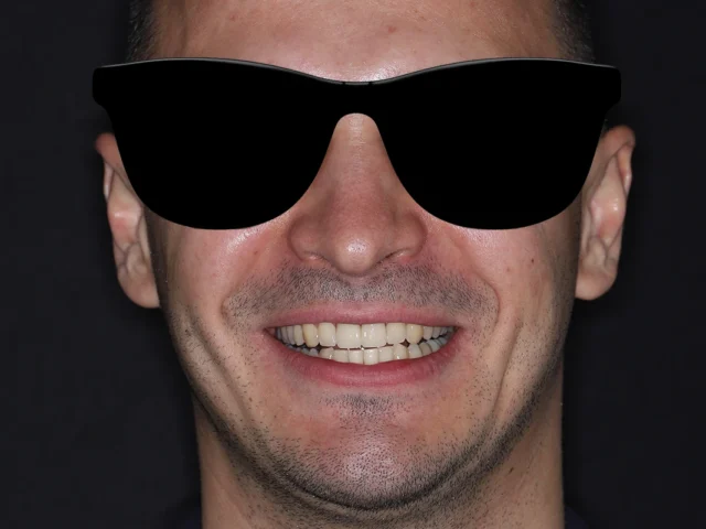 Естетическое восстановление центральных резцов циркониевыми коронками