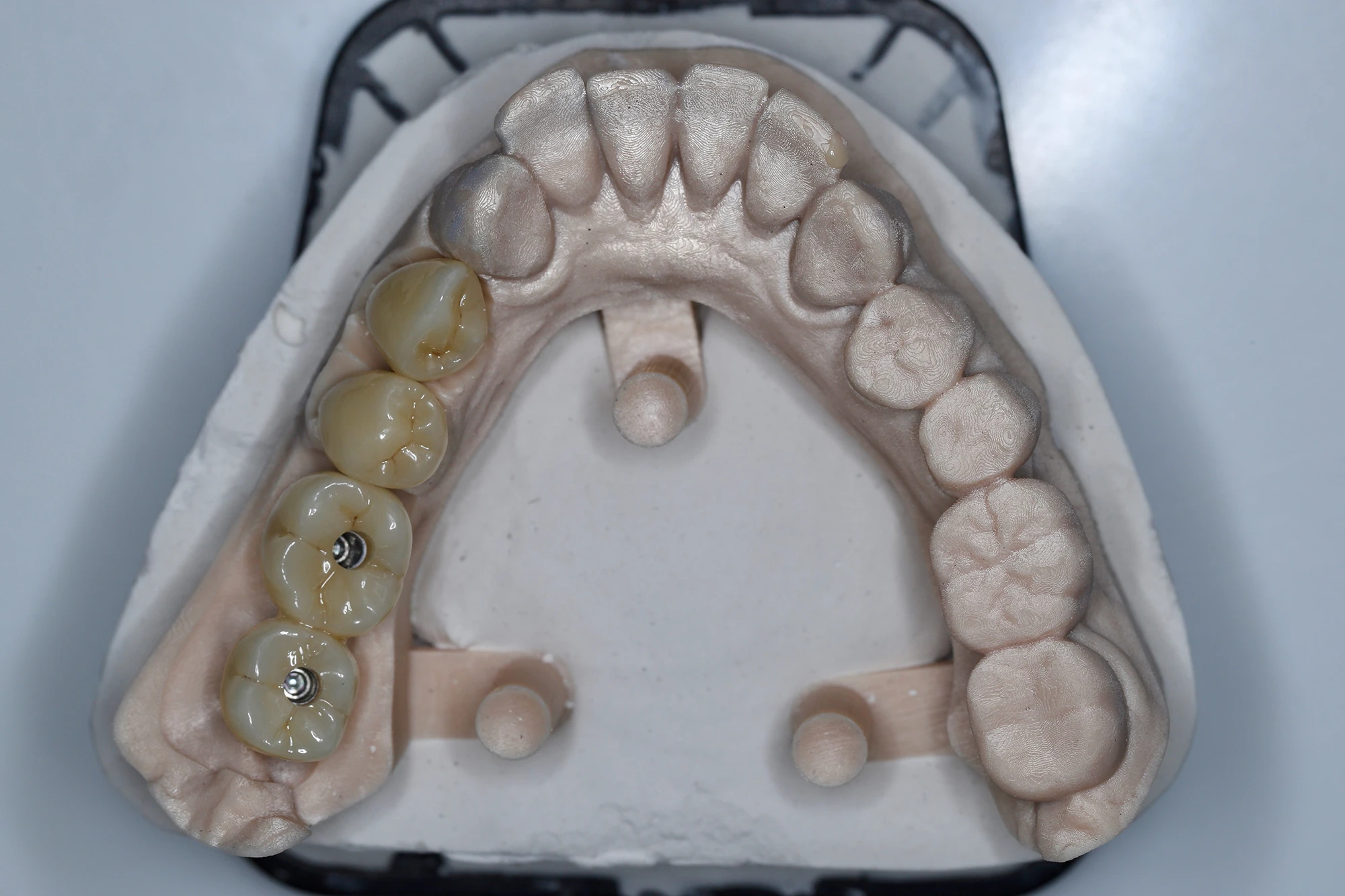2 циркониевые коронки на имплантатах, а также 2 новые полноанатомические циркониевые коронки на зубы 34 и 35