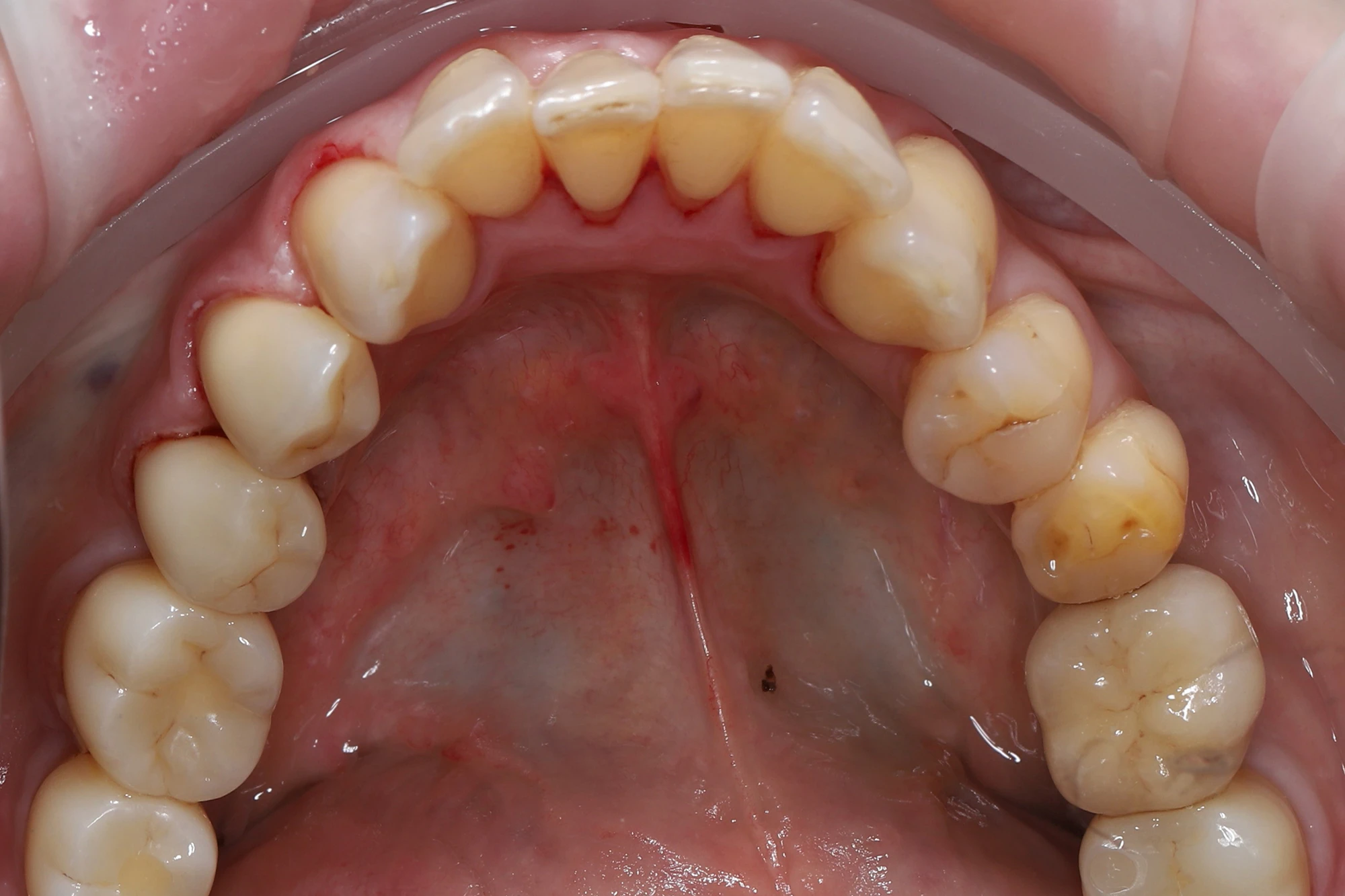 установлены два имплантата Ritter в области 36 и 37 зубов