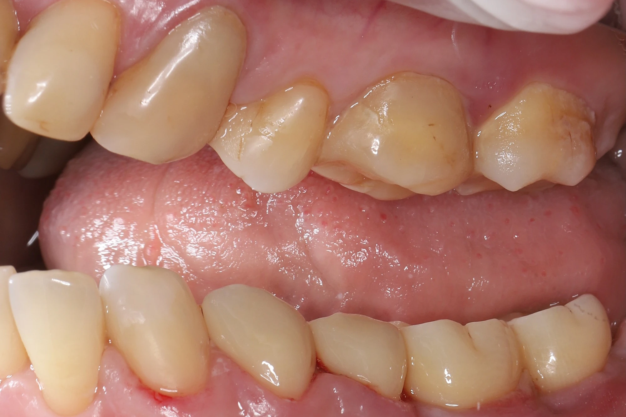 Коронки на имплантатах зафиксированы винтовым способом, на своих зубах - на стеклоиономерный цемент