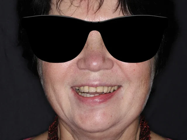 Восстановление жевательной функции нижней челюсти циркониевыми коронками