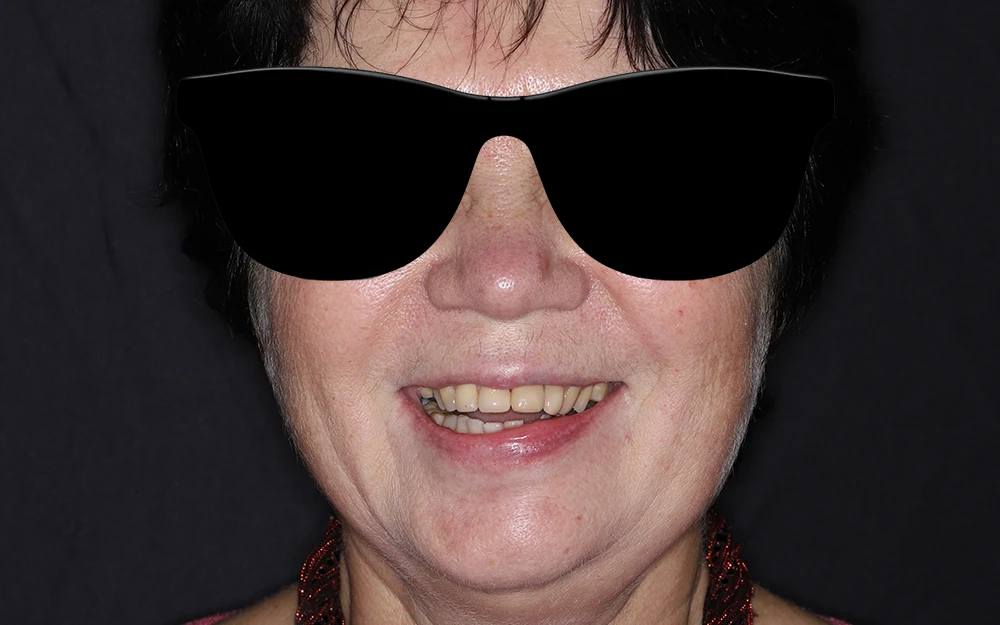 Результат восстановления функции левой стороны нижней челюсти циркониевыми коронками