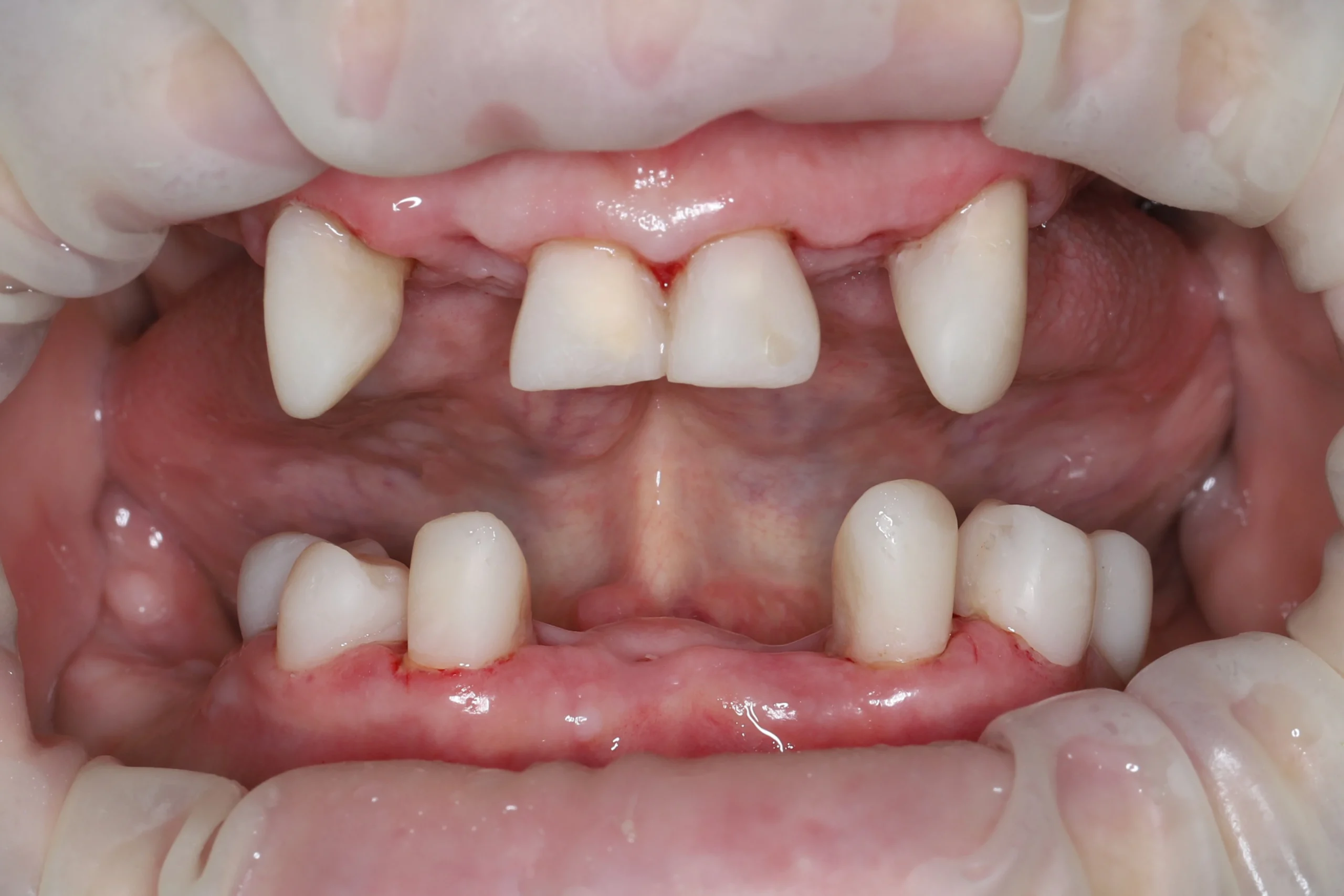 изготовили временные клинические коронки