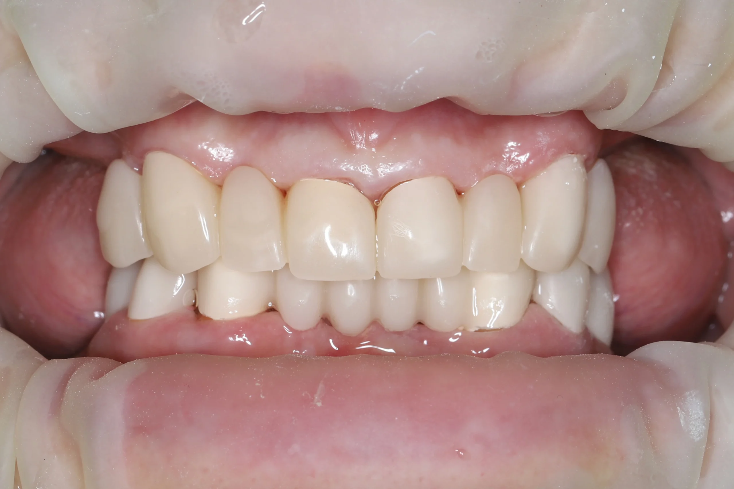 изготовили PMMA-коронки