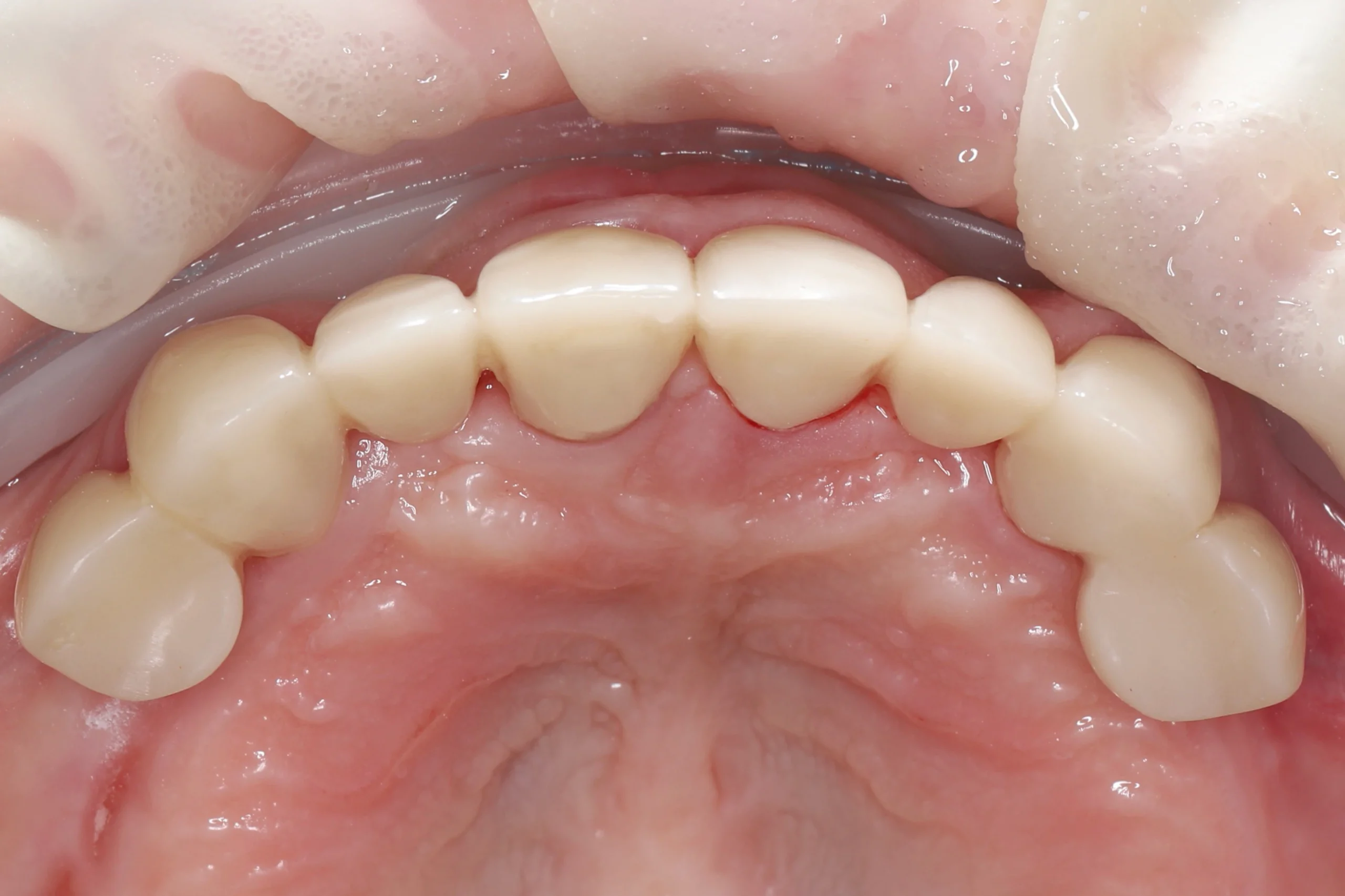 Открытый кюретаж