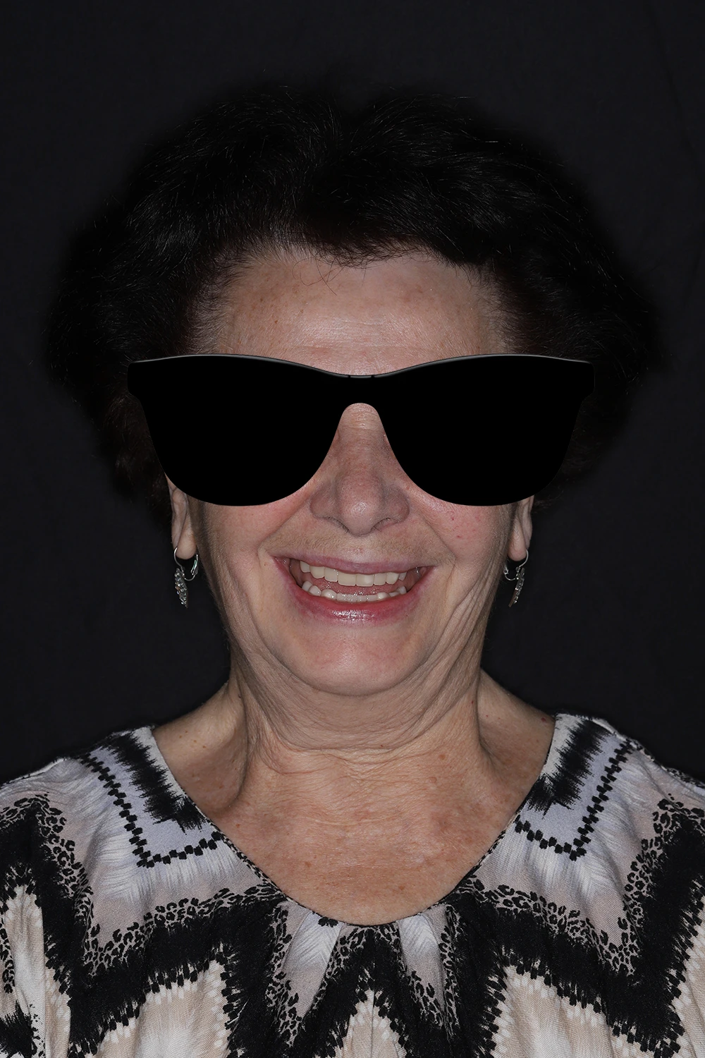 Результаты реабилитации прикуса пациентки