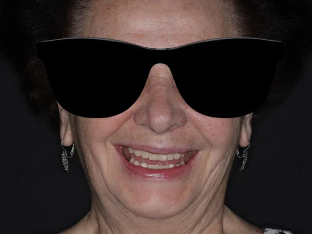 Комплексная реабилитация прикуса при хроническом генерализованном пародонтите