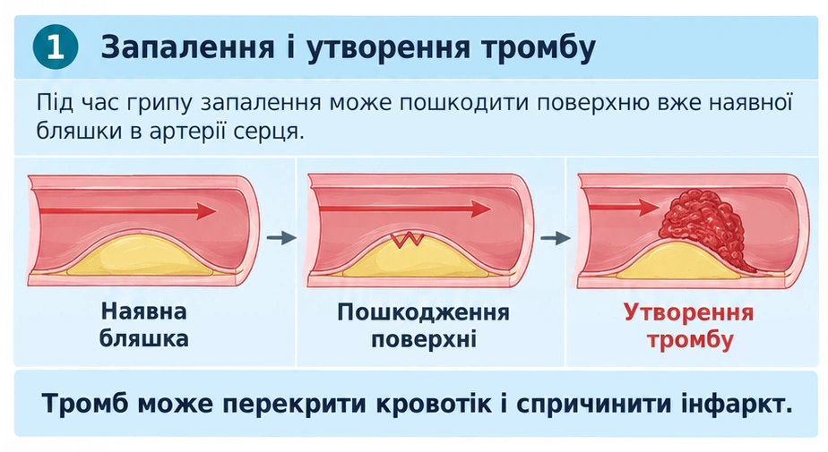 Запалення та атеросклеротичні бляшки
